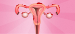 Wat is endometriose?
